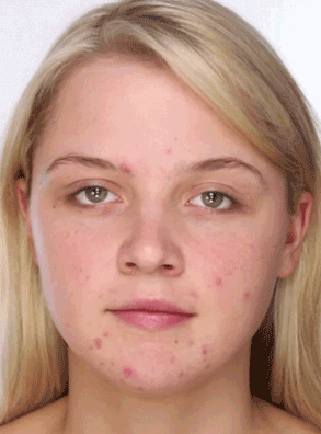 Imagen de una mujer sonriendo con piel clara después de usar el KIT ANTI ACNE BIOAQUA. Incluye Crema Espuma Limpiadora, Sérum Hidratante, Crema Anti Acne y Mascarilla Suavizante para tratamiento eficaz del acné.